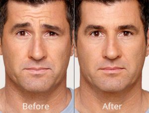 botox-before and after