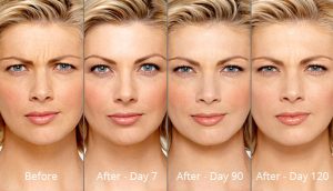 botox-before and after