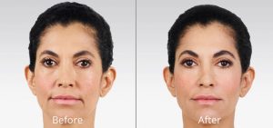 juvederm-before and after