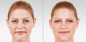 juvederm-before and after