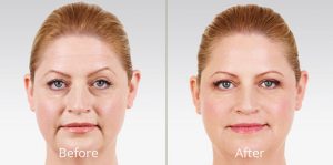 juvederm-before and after