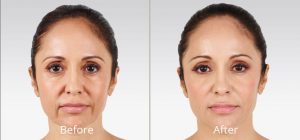 juvederm-before and after