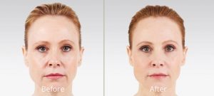 juvederm-before and after