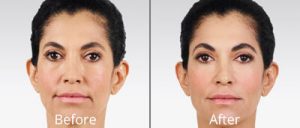 juvederm-before and after