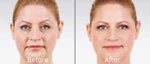 juvederm-before and after