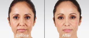 juvederm-before and after