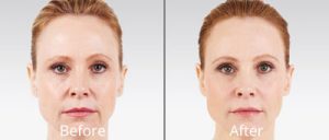 juvederm-before and after