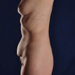 Preop Liposuction of upper and lower abdomen, anterior hips, pubic mons, and Mini Tummy-Tuck