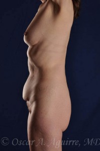 Preop Liposuction of upper and lower abdomen, anterior hips, pubic mons, and Mini Tummy-Tuck