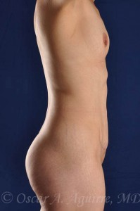 Postop Vaser Liposuction of the upper and lower abdomen, anterior hips and mons as well as a mini Abdominoplasty and revision of her umbilicus