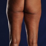 Postop Liposculpture of Thighs and Knees