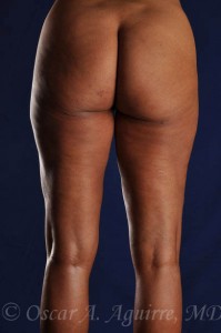 Postop Liposculpture of Thighs and Knees