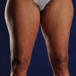 Preop Liposculpture of Thighs and Knees