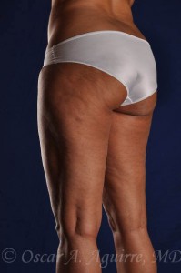 Preop Liposculpture of Thighs and Knees