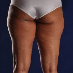 Preop Liposculpture of Thighs and Knees