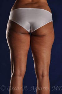 Preop Liposculpture of Thighs and Knees