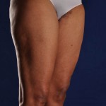 Preop Liposculpture of Thighs and Knees