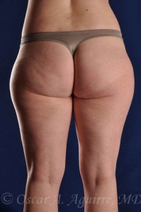 Preop Liposuction