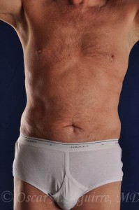 Postop Liposuction of the upper and lower Abdomen, Hips and Flanks
