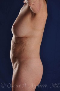 Preop Vaser Liposculpture of the Abdomen, Flanks and Mons areas