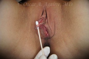 Preop Labiaplasty with Repair of Laceration, Clitoral Hood Reduction with Clitoropexy, O-Shot and PRP (Platelet Rich Plasma) injection