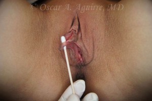 Preop Labiaplasty with Repair of Laceration, Clitoral Hood Reduction with Clitoropexy, O-Shot and PRP (Platelet Rich Plasma) injection