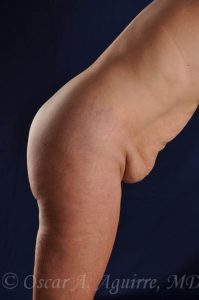Preop Abdominoplasty and Vaser Liposuction of the upper and lower abdomen, flanks, anterior hips and mons