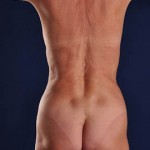 Postop Vaser Liposculpture of the upper and lower abdomen, anterior hips, flanks and mons with a Mini Tummy Tuck