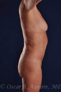 Postop Vaser Liposculpture of the upper and lower abdomen, anterior hips, flanks and mons with a Mini Tummy Tuck