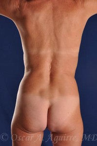 Preop Vaser Liposculpture of the upper and lower abdomen, anterior hips, flanks and mons with a Mini Tummy Tuck