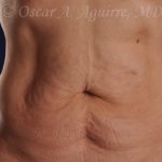 CoolSculpting treatments to Upper and Lower Abdomen, Flanks, Bra Fat, and Arms