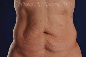 CoolSculpting treatments to Upper and Lower Abdomen, Flanks, Bra Fat, and Arms