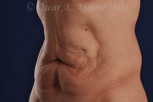 CoolSculpting treatments to Upper and Lower Abdomen, Flanks, Bra Fat, and Arms