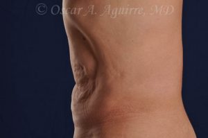 CoolSculpting treatments to Upper and Lower Abdomen, Flanks, Bra Fat, and Arms