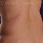 CoolSculpting treatments to Upper and Lower Abdomen, Flanks, Bra Fat, and Arms