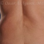 CoolSculpting treatments to Upper and Lower Abdomen, Flanks, Bra Fat, and Arms