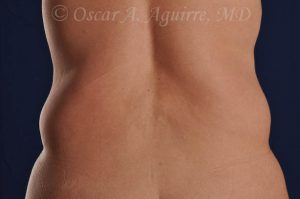 CoolSculpting treatments to Upper and Lower Abdomen, Flanks, Bra Fat, and Arms