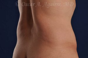 CoolSculpting treatments to Upper and Lower Abdomen, Flanks, Bra Fat, and Arms