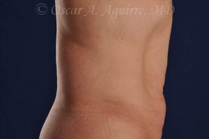 CoolSculpting treatments to Upper and Lower Abdomen, Flanks, Bra Fat, and Arms