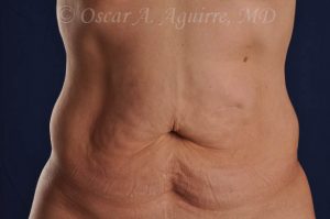 CoolSculpting treatments to Upper and Lower Abdomen, Flanks, Bra Fat, and Arms