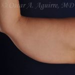 CoolSculpting treatments to Upper and Lower Abdomen, Flanks, Bra Fat, and Arms