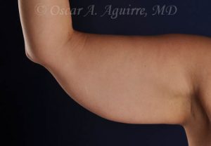 CoolSculpting treatments to Upper and Lower Abdomen, Flanks, Bra Fat, and Arms