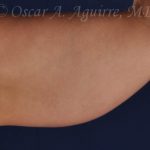 CoolSculpting treatments to Upper and Lower Abdomen, Flanks, Bra Fat, and Arms