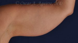 CoolSculpting treatments to Upper and Lower Abdomen, Flanks, Bra Fat, and Arms