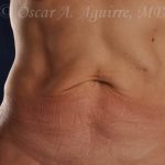 CoolSculpting treatments to Upper and Lower Abdomen, Flanks, Bra Fat, and Arms