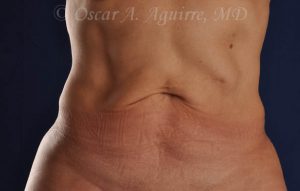 CoolSculpting treatments to Upper and Lower Abdomen, Flanks, Bra Fat, and Arms