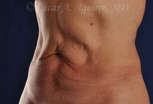 CoolSculpting treatments to Upper and Lower Abdomen, Flanks, Bra Fat, and Arms