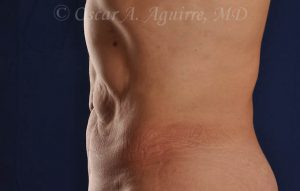 CoolSculpting treatments to Upper and Lower Abdomen, Flanks, Bra Fat, and Arms