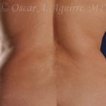 CoolSculpting treatments to Upper and Lower Abdomen, Flanks, Bra Fat, and Arms