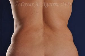 CoolSculpting treatments to Upper and Lower Abdomen, Flanks, Bra Fat, and Arms